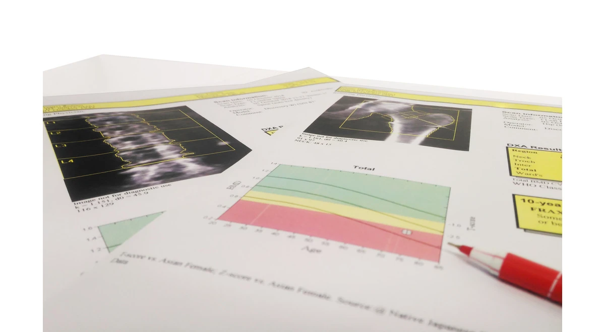Osteodensitometrie cu ultrasunete vs cu radiații (DEXA) - care sunt diferențele?